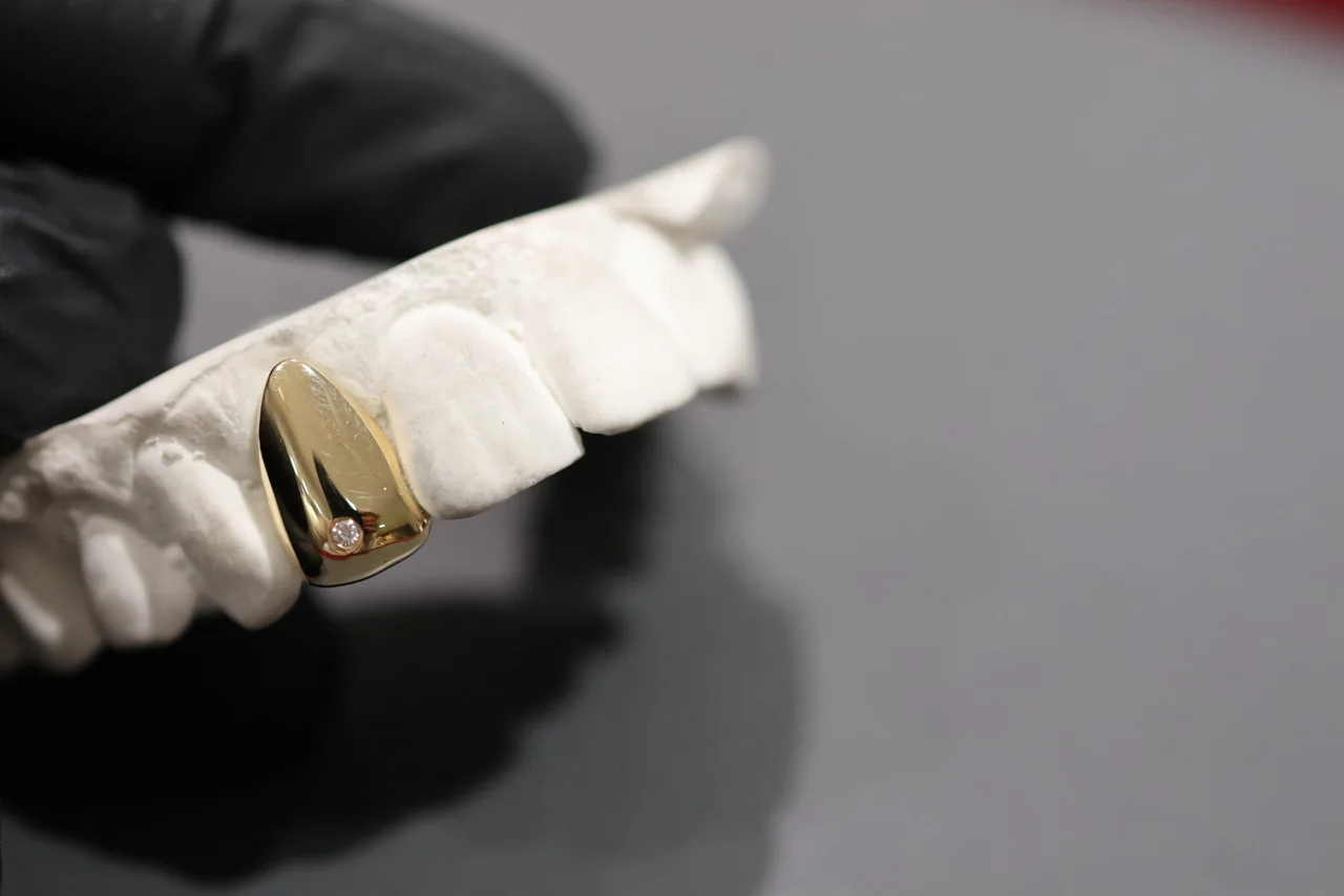 A custom gold grill on a dental impression, held in a gloved hand